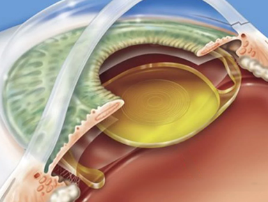 Lentes Intraoculares Premium